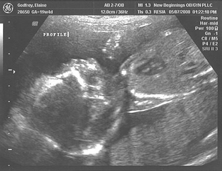 Baby at 18 weeks